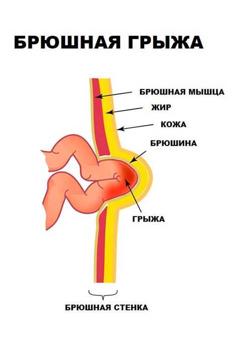 Причины рецидивов грыжи и способы их предотвращения