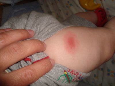 покраснение на ноге