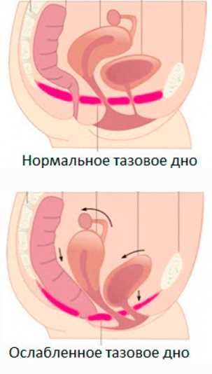 Как избежать повышенного риска синдрома обтурации при чревной грыже