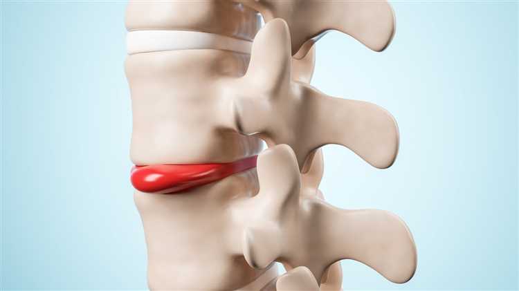 Правильное питание при грыже для здоровья кишечника