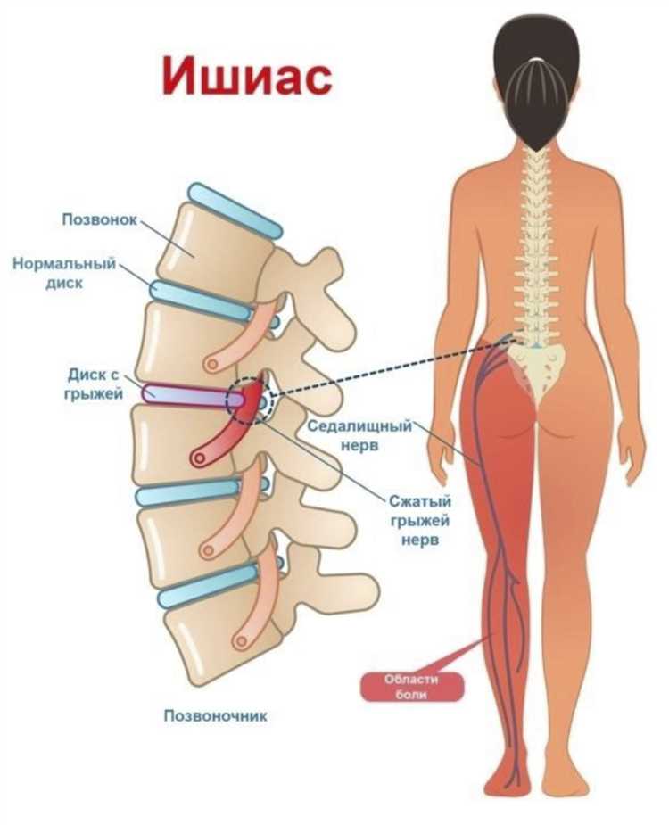Признаки грыжи и необходимость обращения к врачу