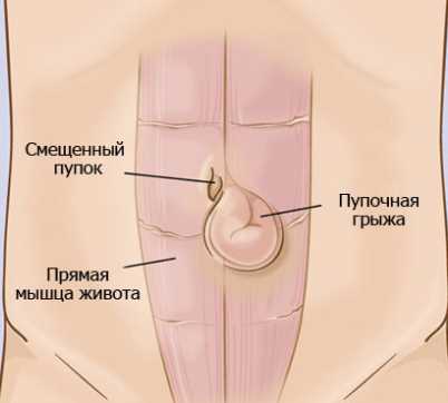 Признаки и симптомы грыжи когда обращаться к врачу