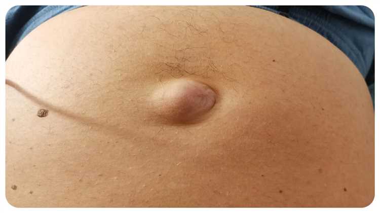 Признаки пупочной грыжи как не упустить важные моменты