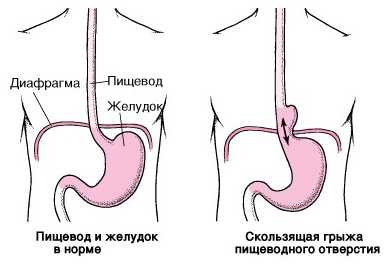 Профилактика диафрагмальных грыж советы врачей