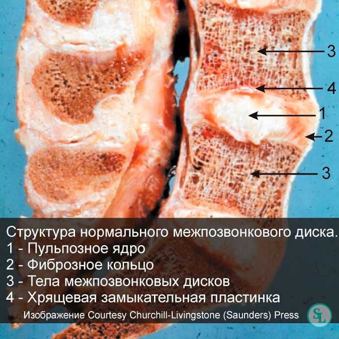 Протрузия и грыжа различия симптомы и методы лечения