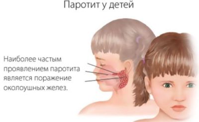 проявления паротита