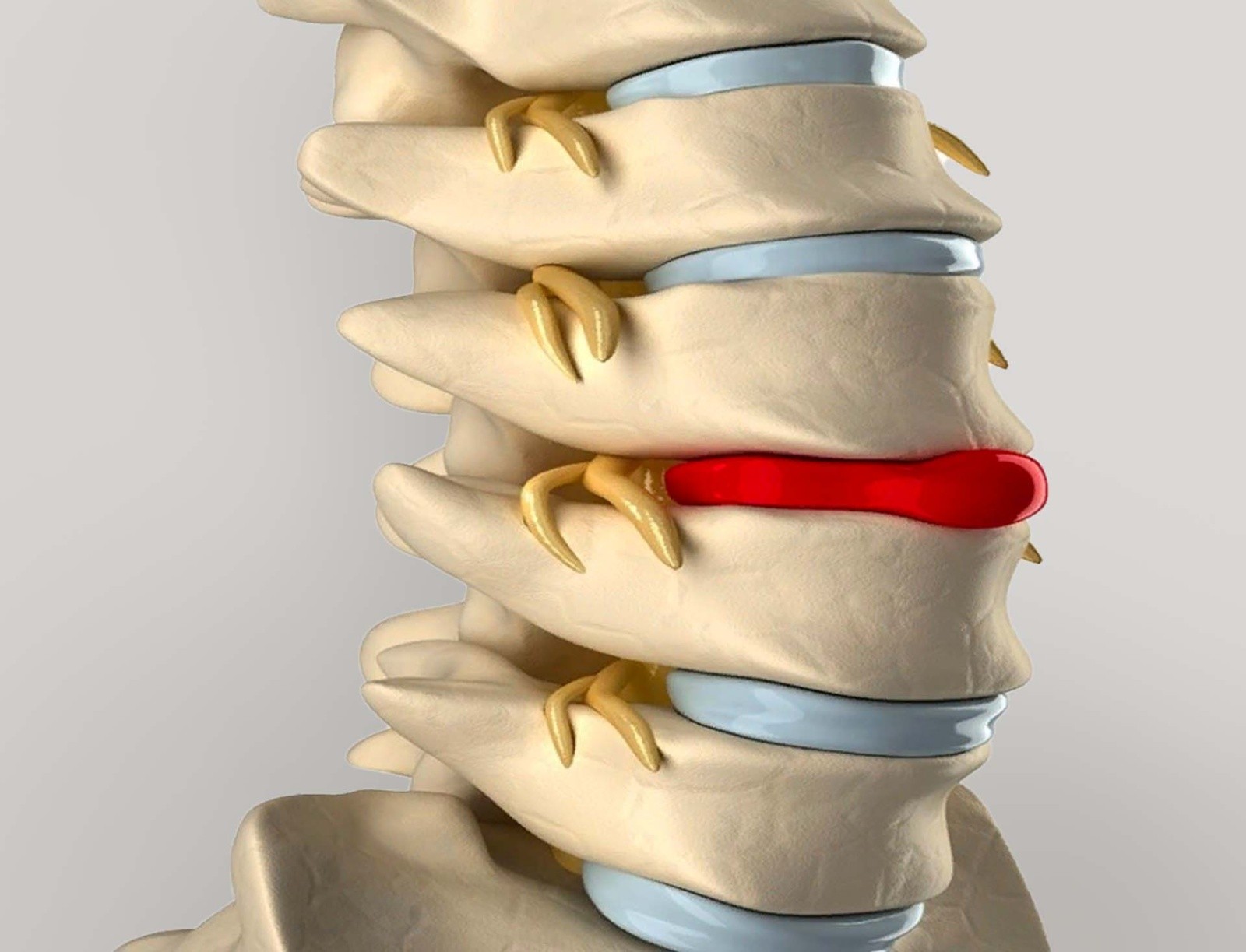 Психология и жизнь с грыжей как преодолеть трудности