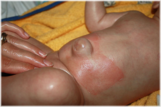 грыжа у малыша