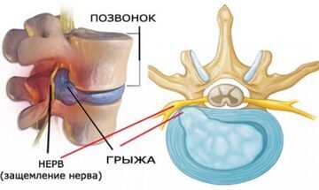 Реабилитация после операции на грыже что ожидать