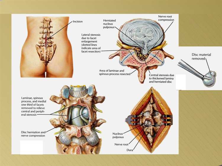 Эффективная реабилитация после операции на грыжу советы и рекомендации