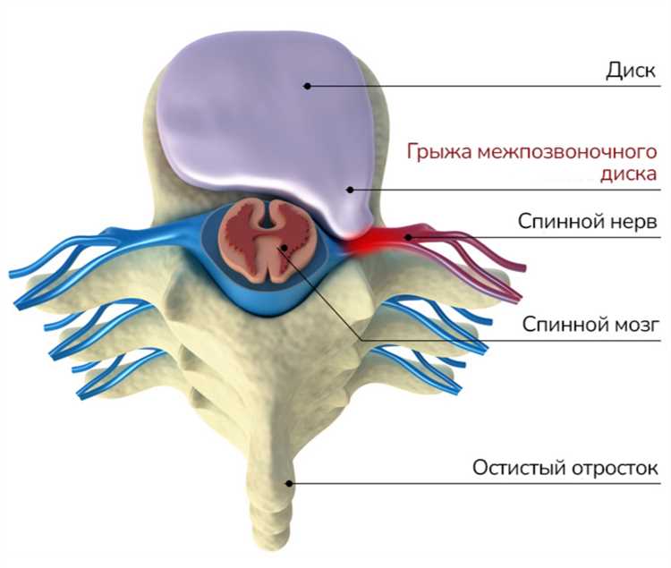 Рекомендации по питанию при грыже для поддержания здоровья