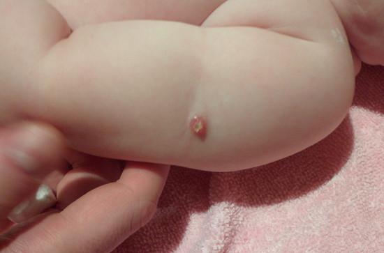 рубец от прививки