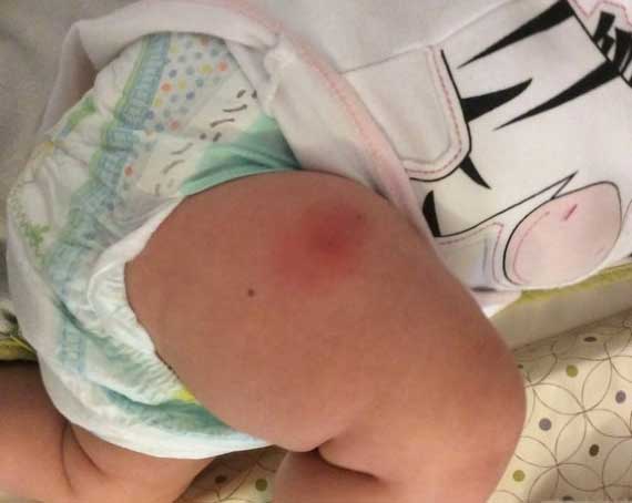 шишка на ноге