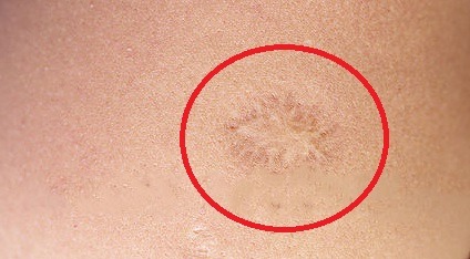 след от БЦЖ