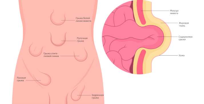 Эффективные методы оказания первой помощи при обострении грыжи