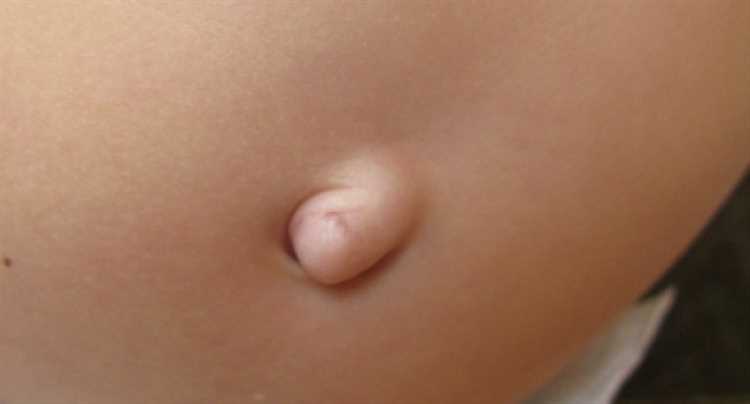 Как самостоятельно проверить наличие грыжи в домашних условиях