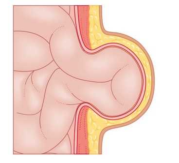 Типы грыж и их влияние на качество жизни