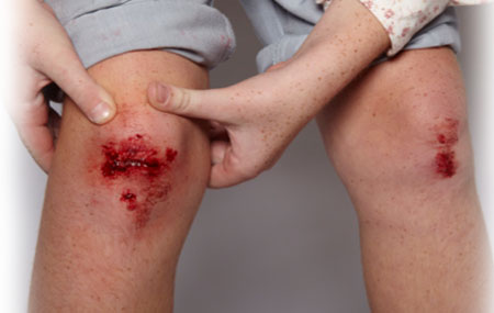 травма колена