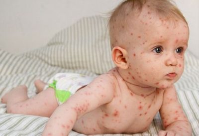 у ребенка ветрянка