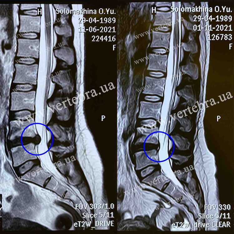 Истории успешного лечения грыжи советы от тех кто прошел через это