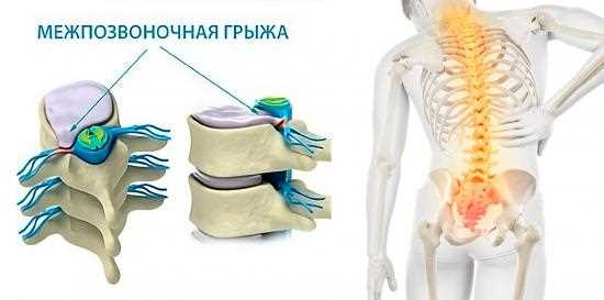 Влияние грыжи на качество жизни и способы преодоления ограничений