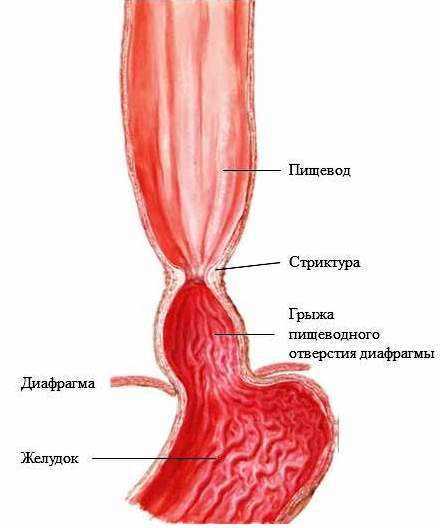 Влияние стресса на развитие грыжи научные данные