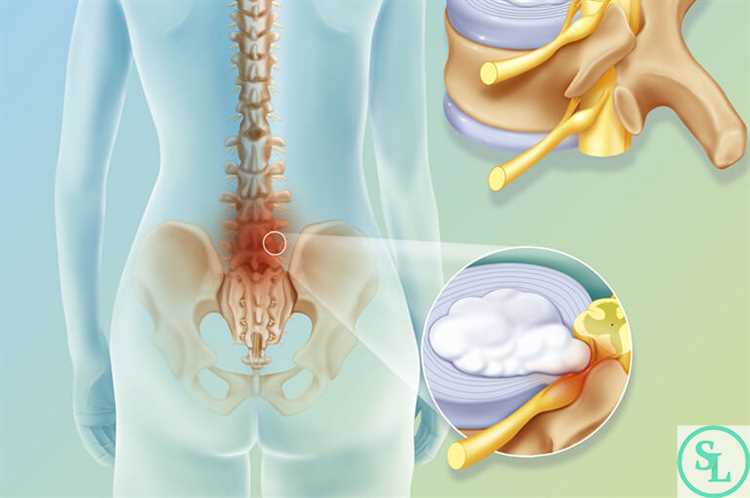 Грыжа Понимание и Лечение Заболевания