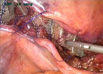 Все что нужно знать о хирургическом лечении грыжи перед операцией