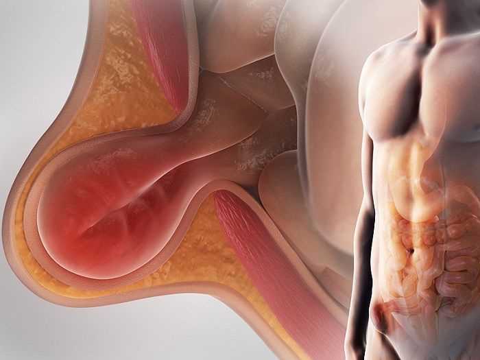 Хирургическое вмешательство при паховой грыже показания и противопоказания