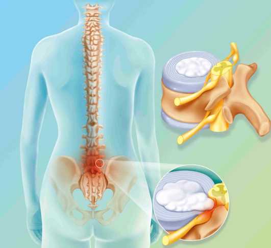 Как предотвратить нагрузки и травмы при заболеваниях поясничной грыжи